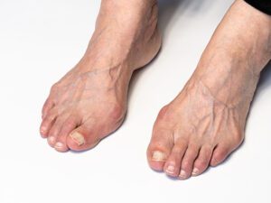 Juanetes o Hallux Valgus - Clinica del campestre
