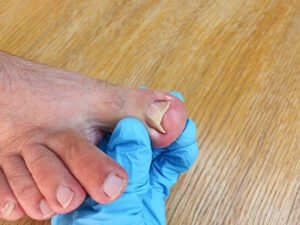 Uñas encarnadas - Clinica del campestre