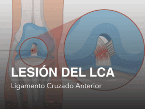 LCA