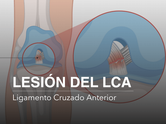 LCA